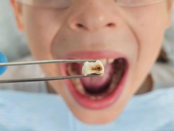 Best Urgent Care for Lost Fillings or Crowns in Tea, SD