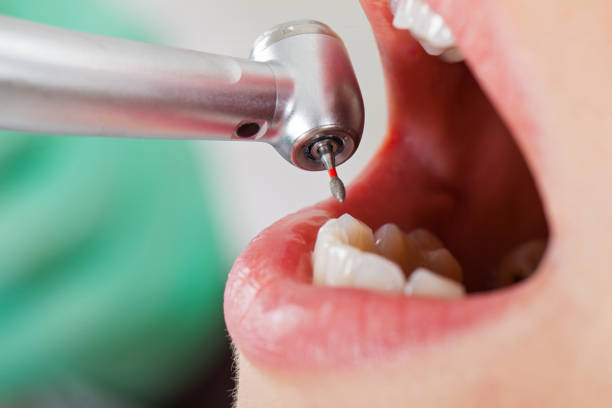 Best Emergency Tooth Extraction in Tea, SD